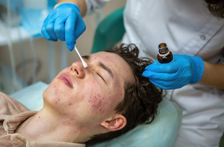 Understanding Hormonal & Cystic Acne: Why Root-Cause Homeopathy Treatment Outperforms Surface Solutions